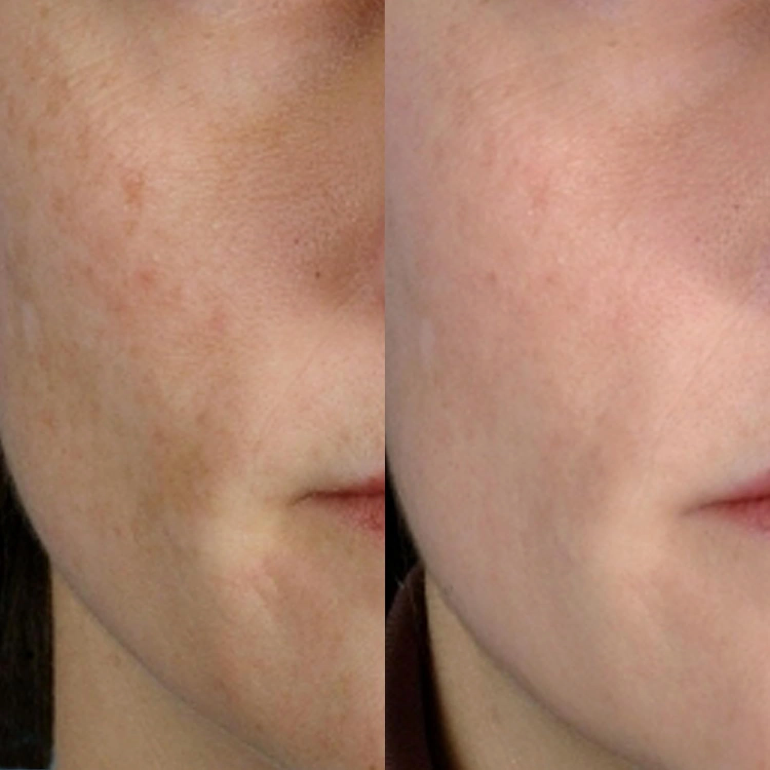 PMD Personal Microderm Classic - At-Home Microdermabrasion Machine with Kit for Face & Body